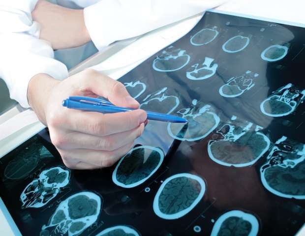 یافته های جدید طیف ژنوتیپی صرع کانونی مرتبط با NPRL3 را گسترش می دهد