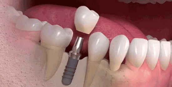 ایمپلنت دندان چیست؟ مزایا و معایب آن