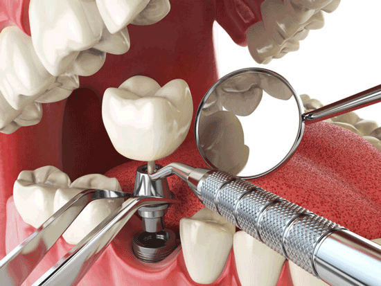 ایمپلنت دندان چیست؟ مزایا و معایب آن
