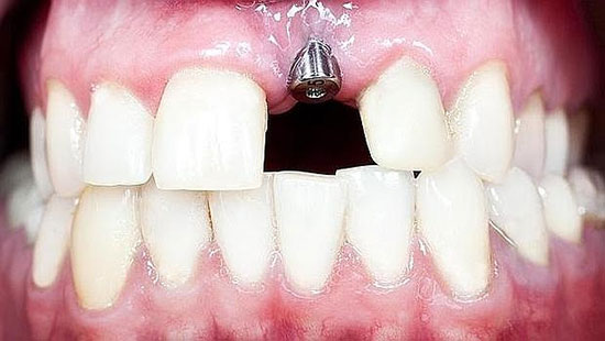 ایمپلنت دندان های جلویی