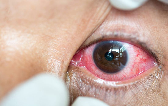 چرا خوابیدن با لنز مضر است؟