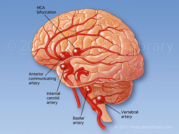 آنوریسم مغزی، علت‌ها، علائم و درمان