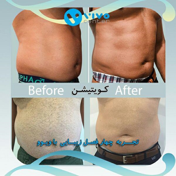 لاغری با کویتیشن، غیرتهاجمی و بدون درد