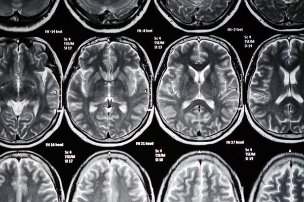 ریسک فاکتورهای سکته مغزی که می‌توانید کنترل‌شان کنید