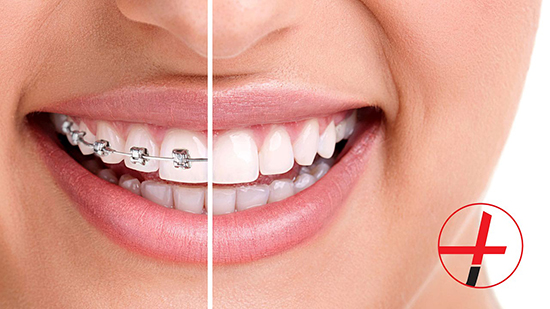 ارتودنسی یا کامپوزیت؟ برای دندان شما کدام بهتر است؟