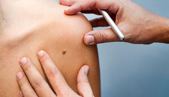 خال‌برداری با لیزر یا جراحی؟