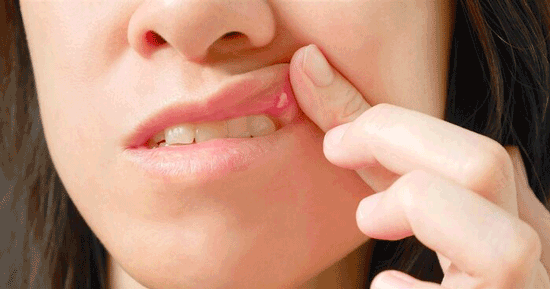 درمان‌های خانگی برای درمان آفت دهان