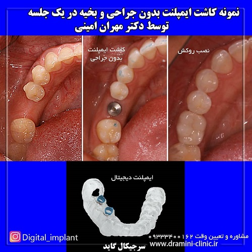 کاشت دندان، دکتر مهران امینی