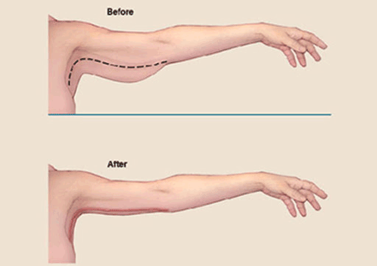 جراحی لیفت بازو یا براکیوپلاستی